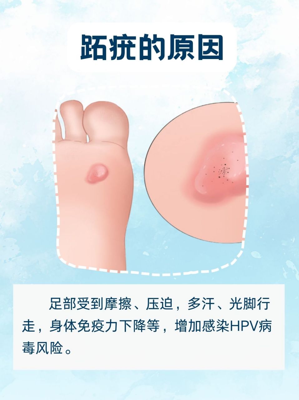 98跖疣是一种由人乳头瘤病毒(hpv)引起的皮肤感染.
