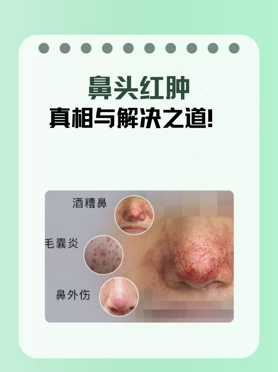 95鼻头红肿的原因主要有四点:   11566过敏反应:花粉,尘螨