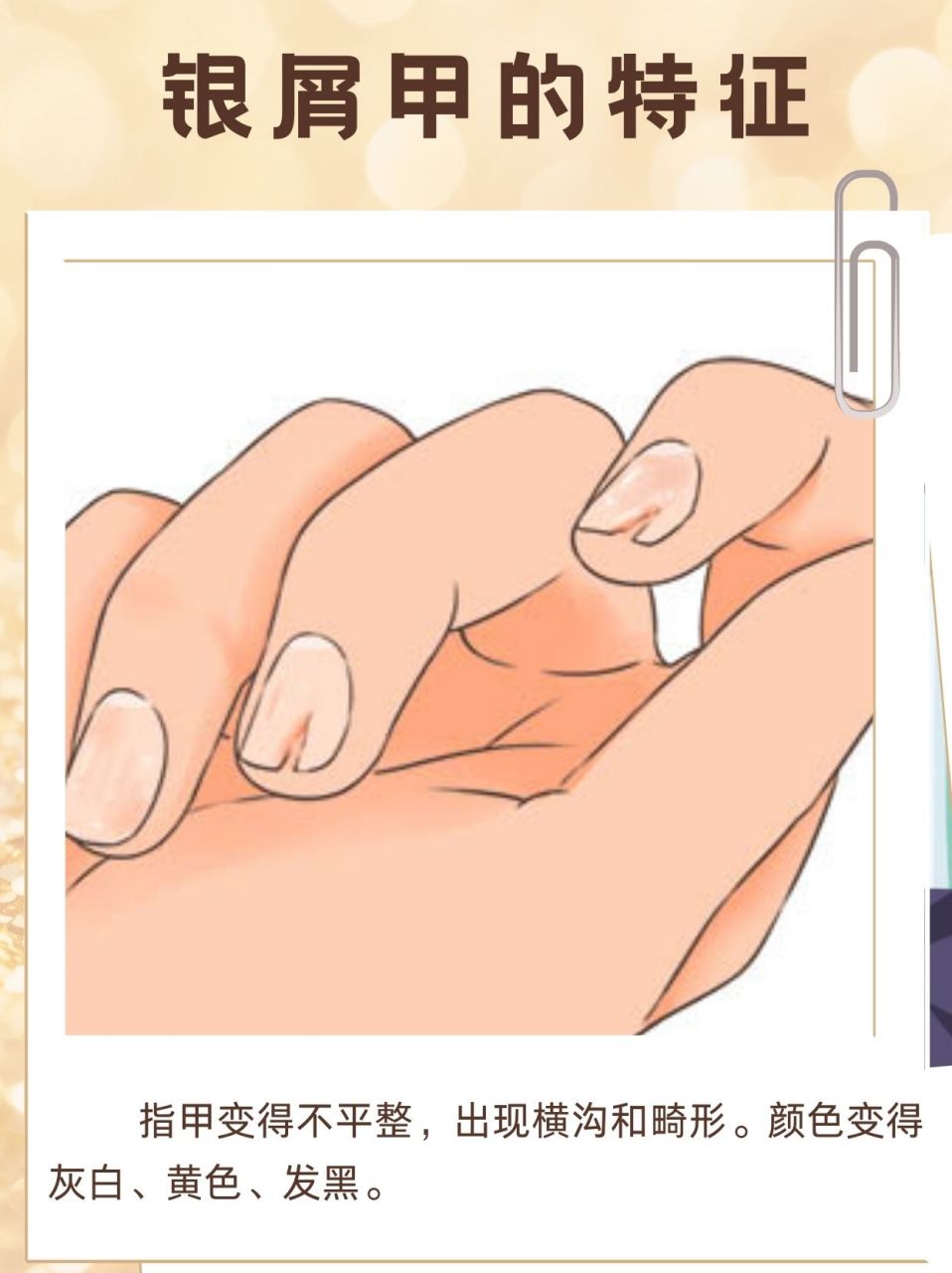 指甲表面会变得不平整,出现凹凸形状,甚至可能出现横沟和畸形