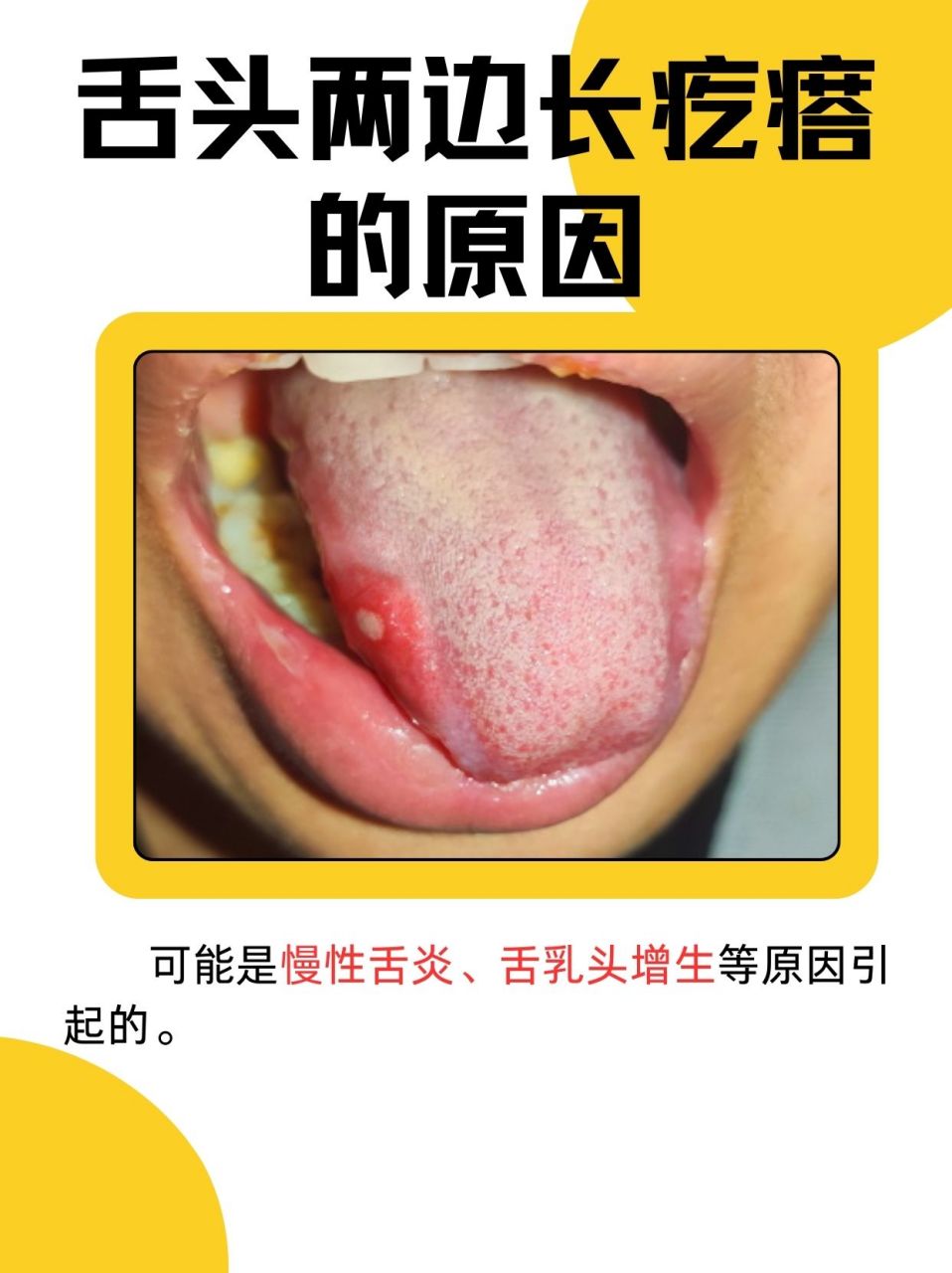 98舌头两边长疙瘩可能是口腔溃疡,慢性舌炎,舌乳头增生等原因