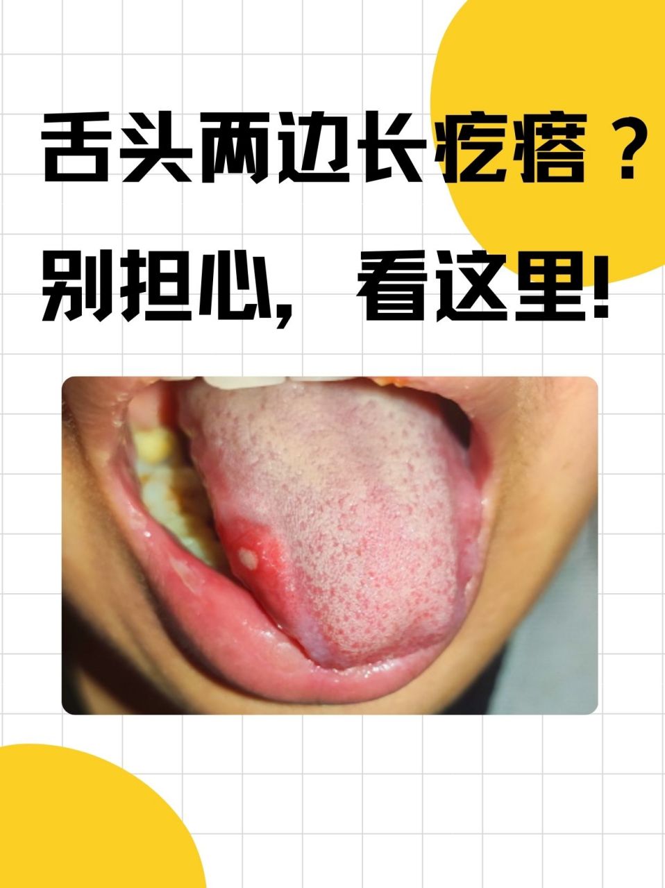 98舌头两边长疙瘩可能是口腔溃疡,慢性舌炎,舌乳头增生等原因