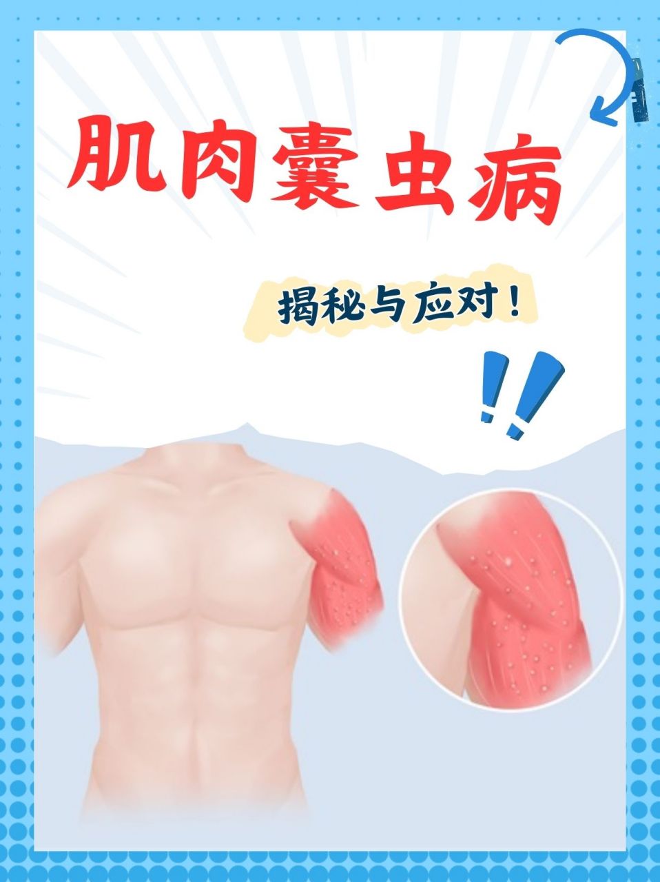 95肌肉囊虫病是由猪肉绦虫的幼虫寄生于人体肌肉组织所引起的一