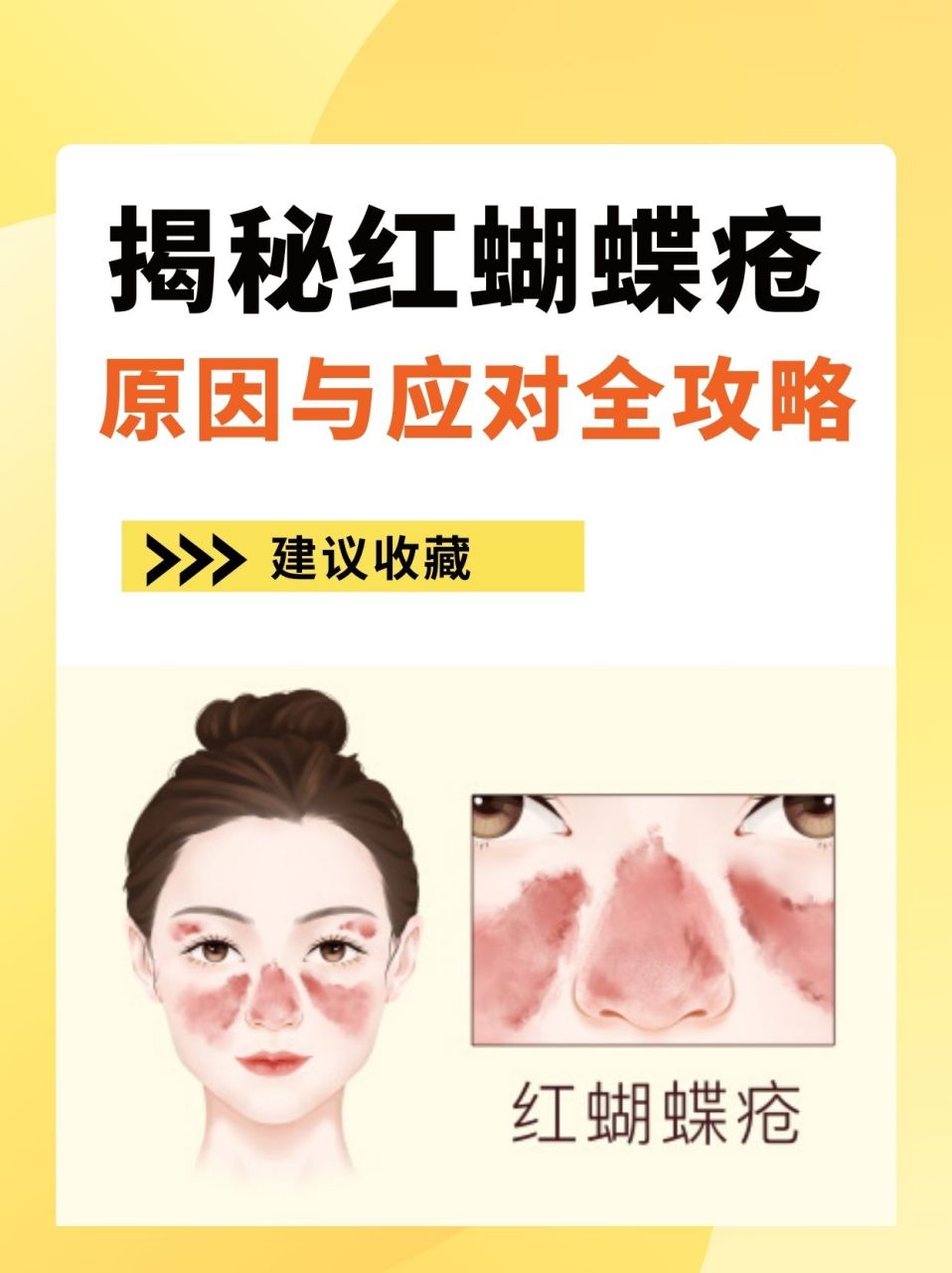 94红蝴蝶疮,是一种以面及手等暴露部位皮肤红斑,鳞屑,萎缩为特征