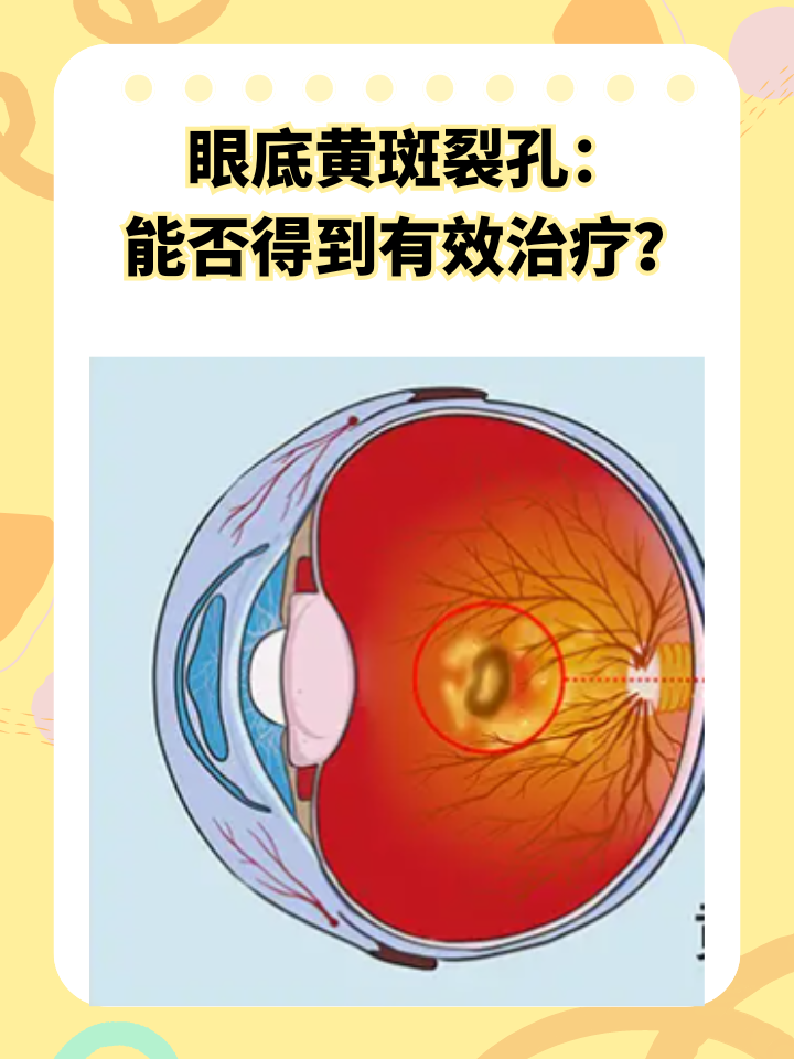 在眼科疾病中,眼底黄斑裂孔是一种较为常见且严重的状况,它直接影响