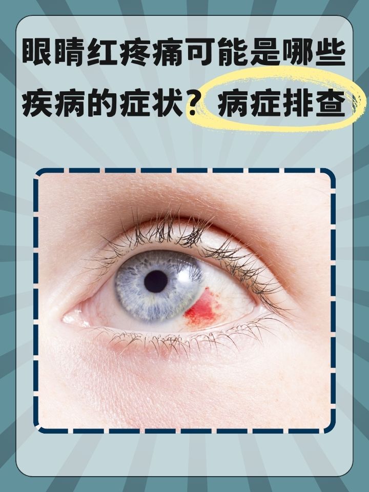 病症排查  在日常生活中,眼睛红疼痛是一个常见的