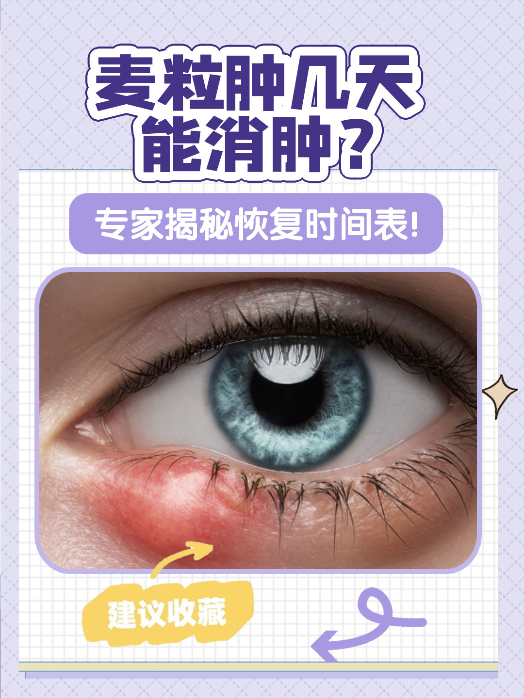 麦粒肿几天能消肿?专家揭秘恢复时间表!