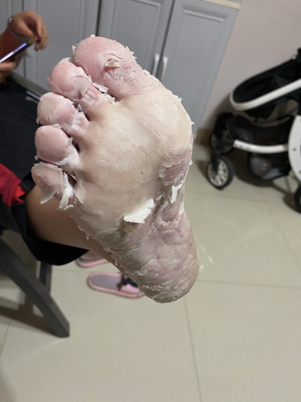 初期可能只是脚后跟轻微脱屑,逐渐发展为皲裂,角化过度等貌似"皮肤