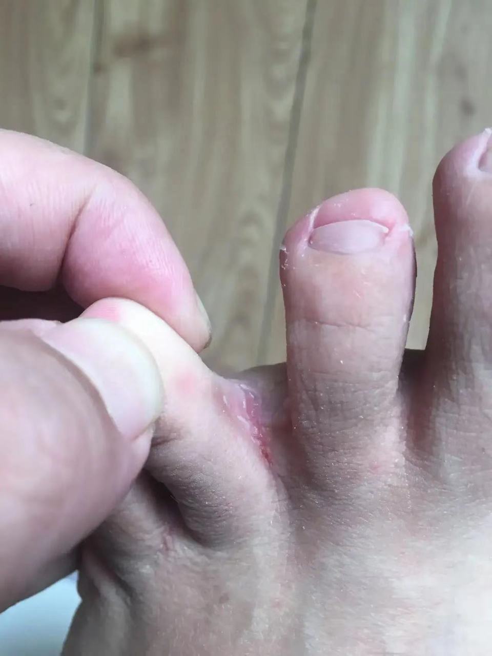 大人有脚气会传染孩子吗?