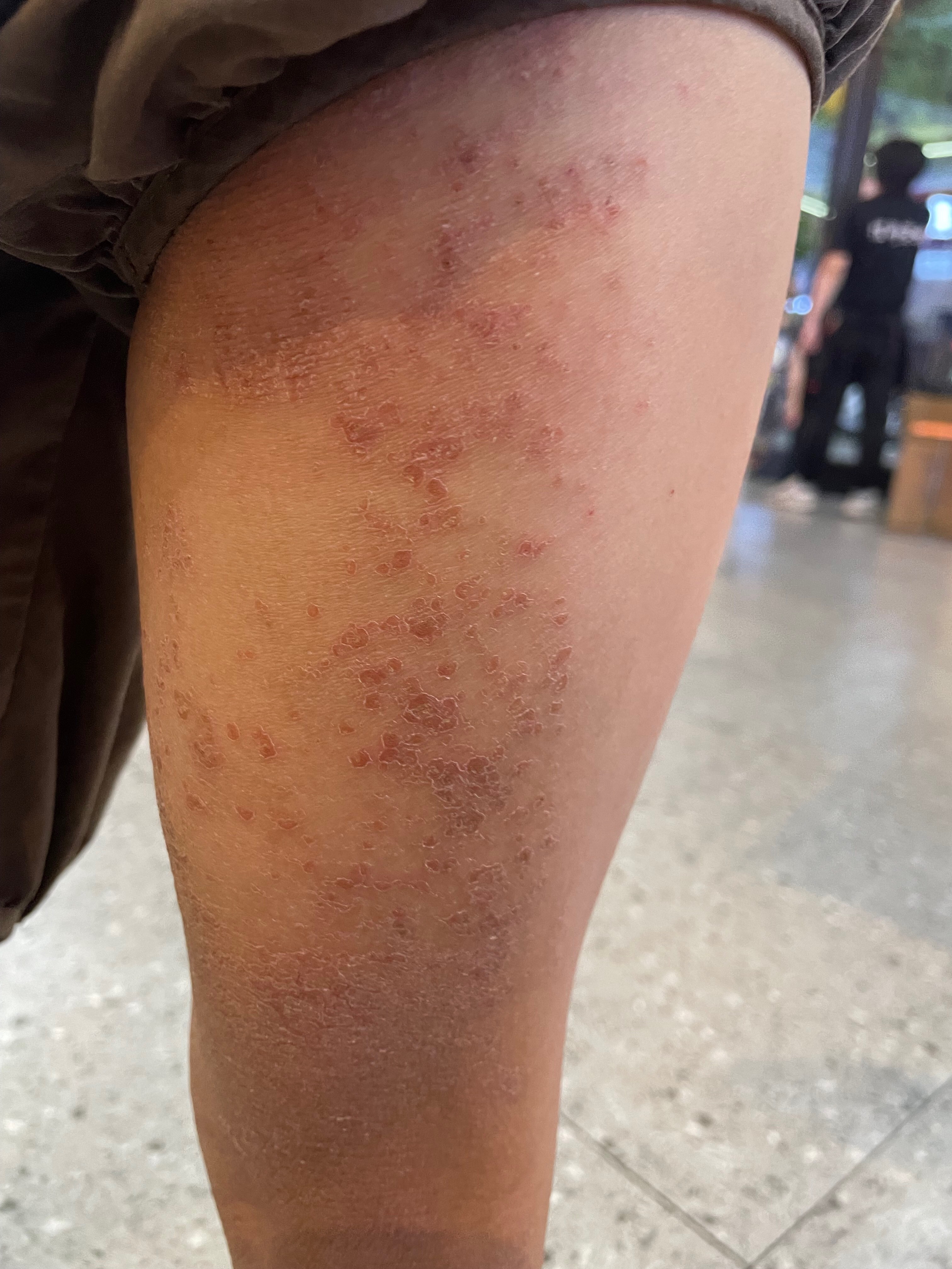 干疮是什么样子的图片干燥综合症皮疹图片干疮的症状图片干疮图片干疮