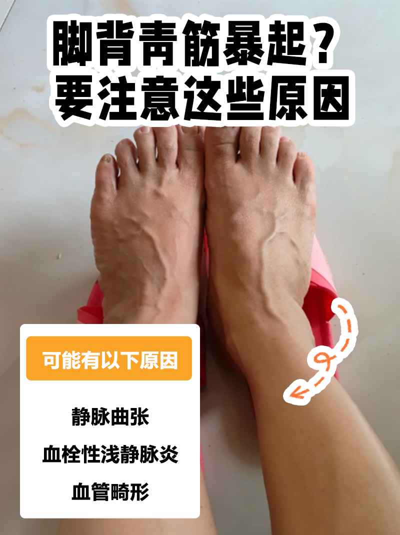 脚背青筋暴起,可能有以下原因 静陆疟 静脉曲张早期图片脚面静脉曲 