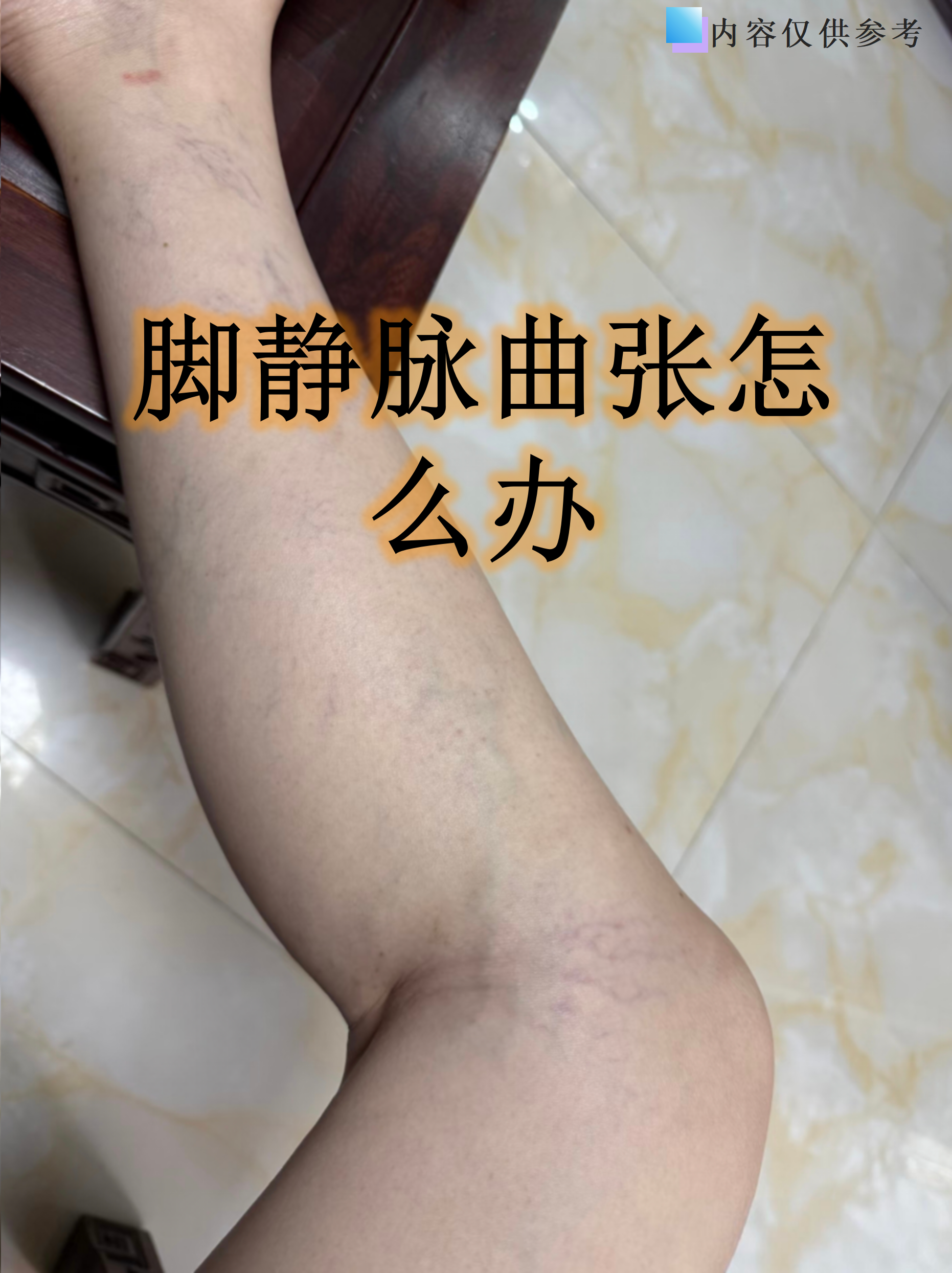 脚上爬满像蚯蚓一样的青筋,静脉曲张可不是简单的