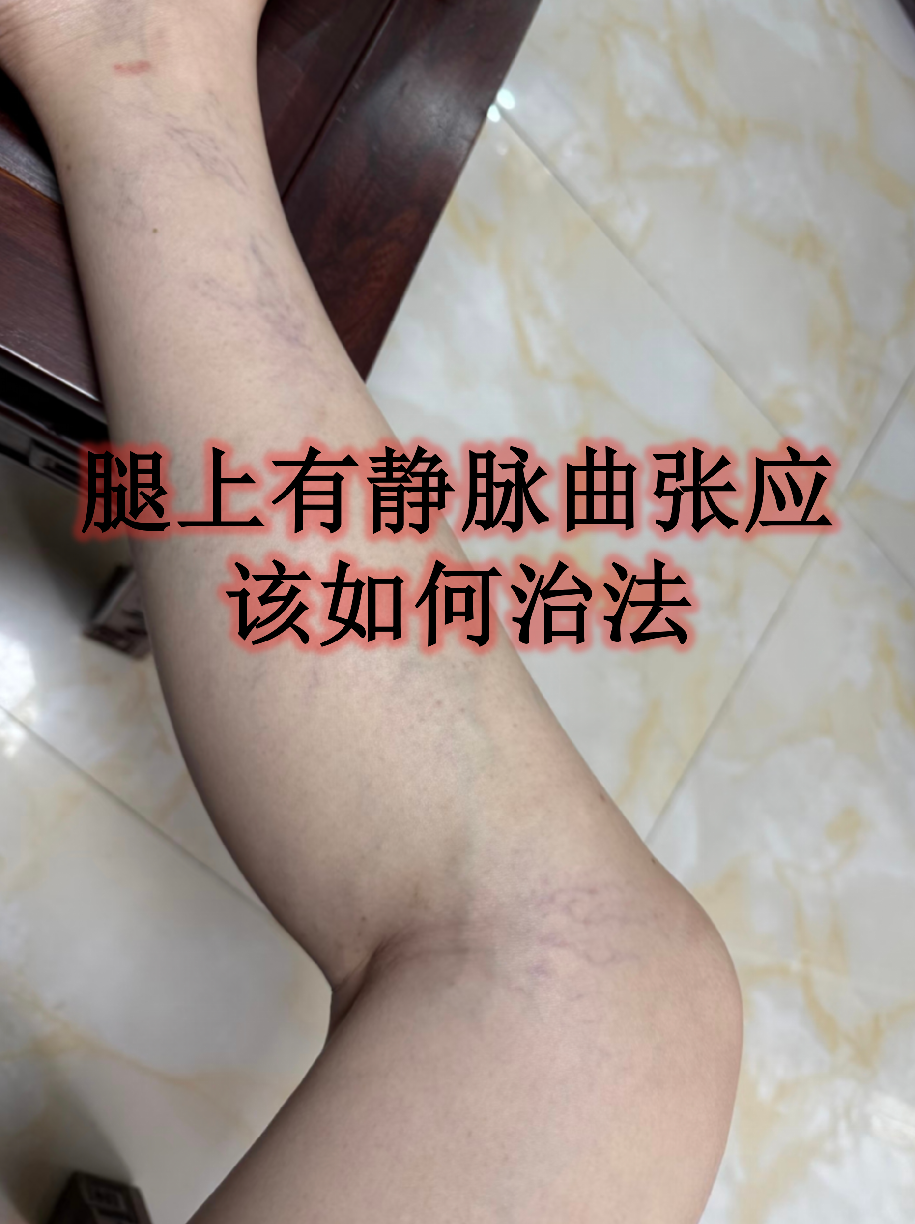 腿上有静脉曲张应该如何治法