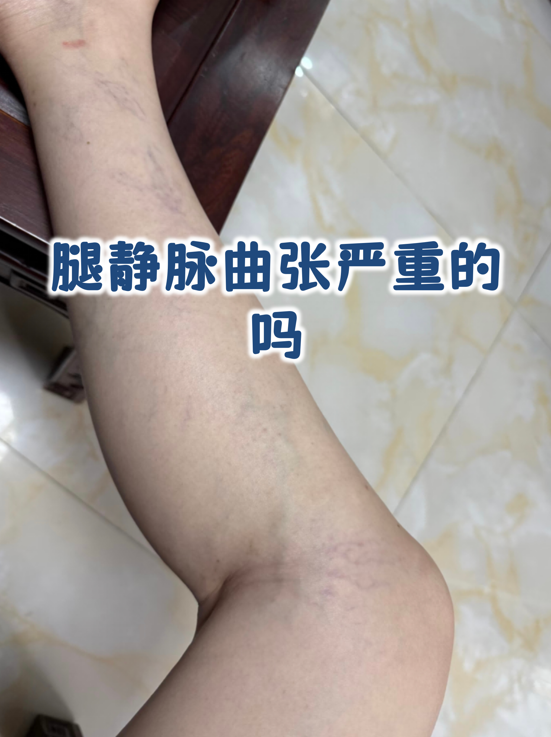 腿静脉曲张是否严重,关键要看发展阶段和症状