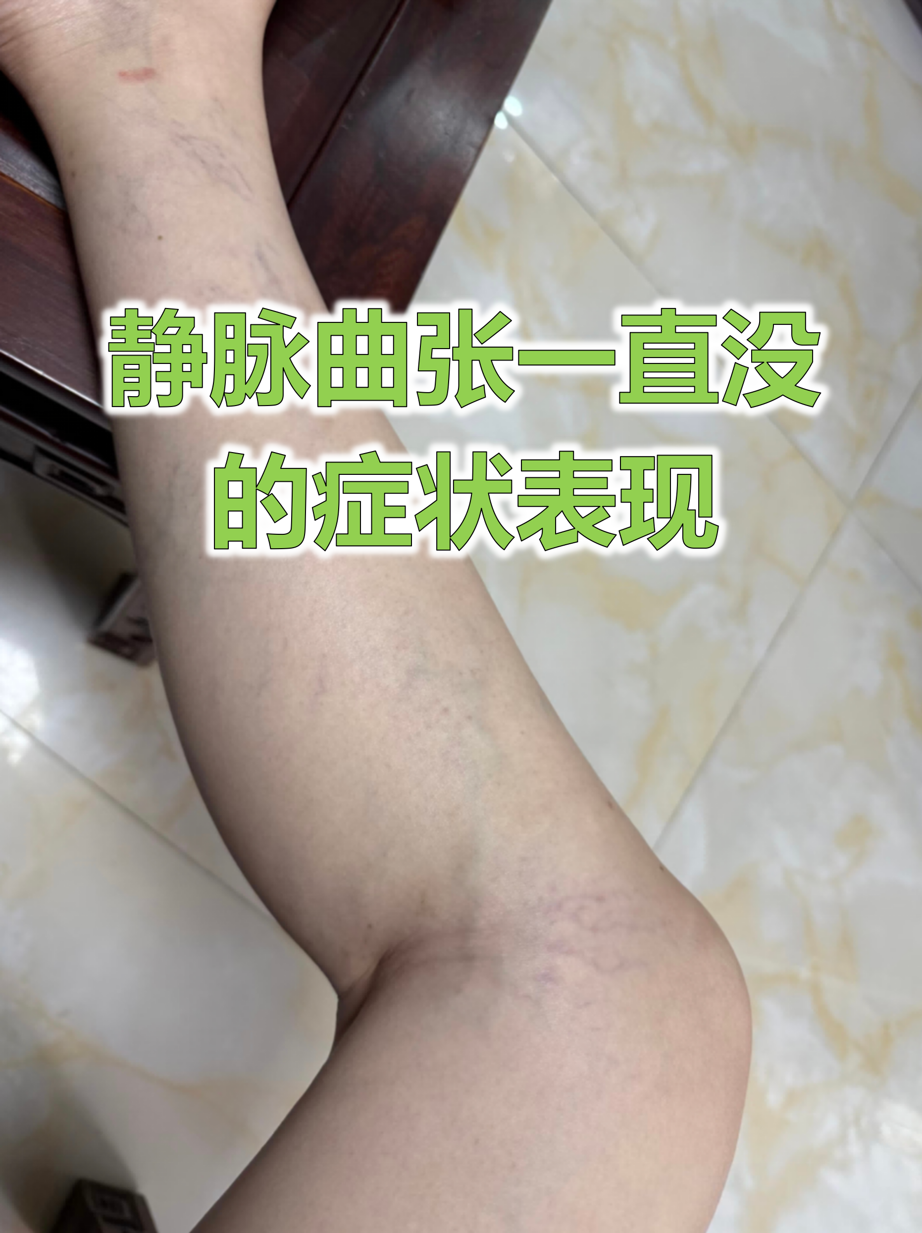 静脉曲张症状表现 轻度表现:久站后小腿酸胀,沉重感傍晚