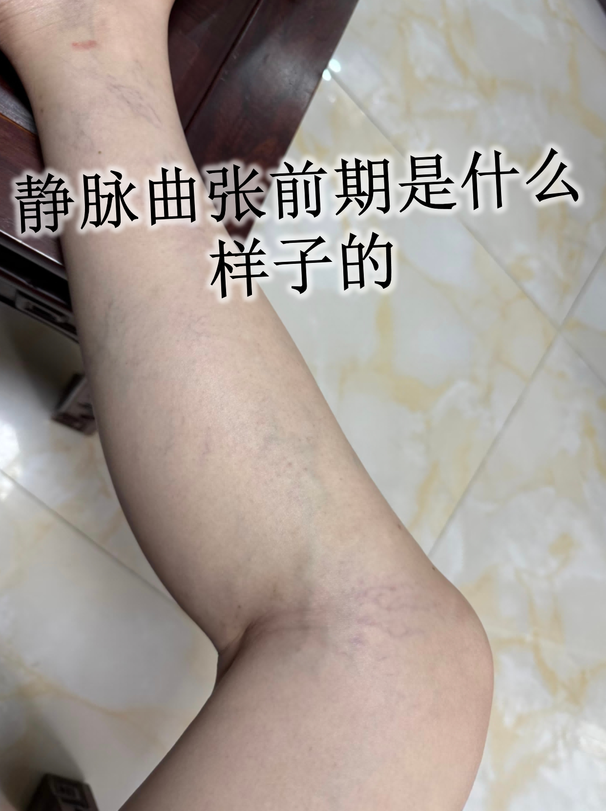 静脉曲张前期表现 轻微血管显露:久站后小腿出现细小