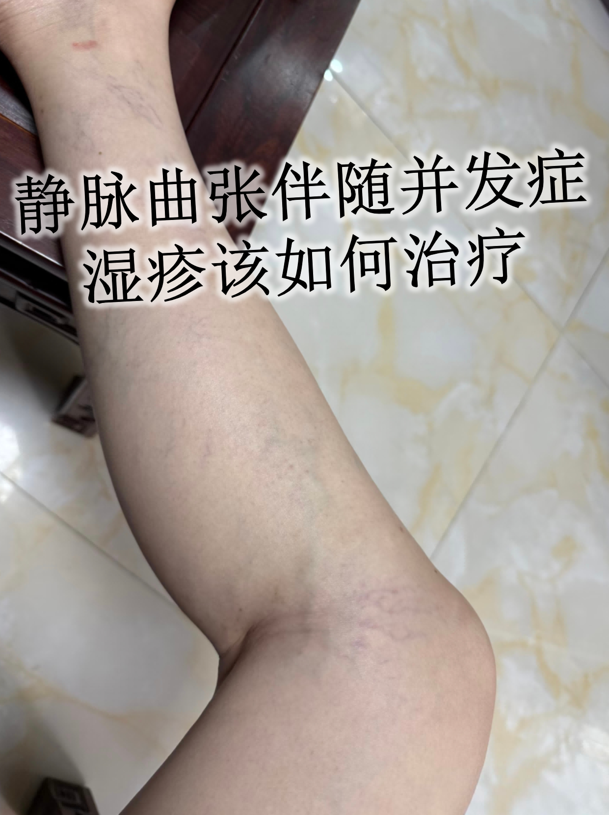 静脉曲张伴随并发症湿疹该如何治疗
