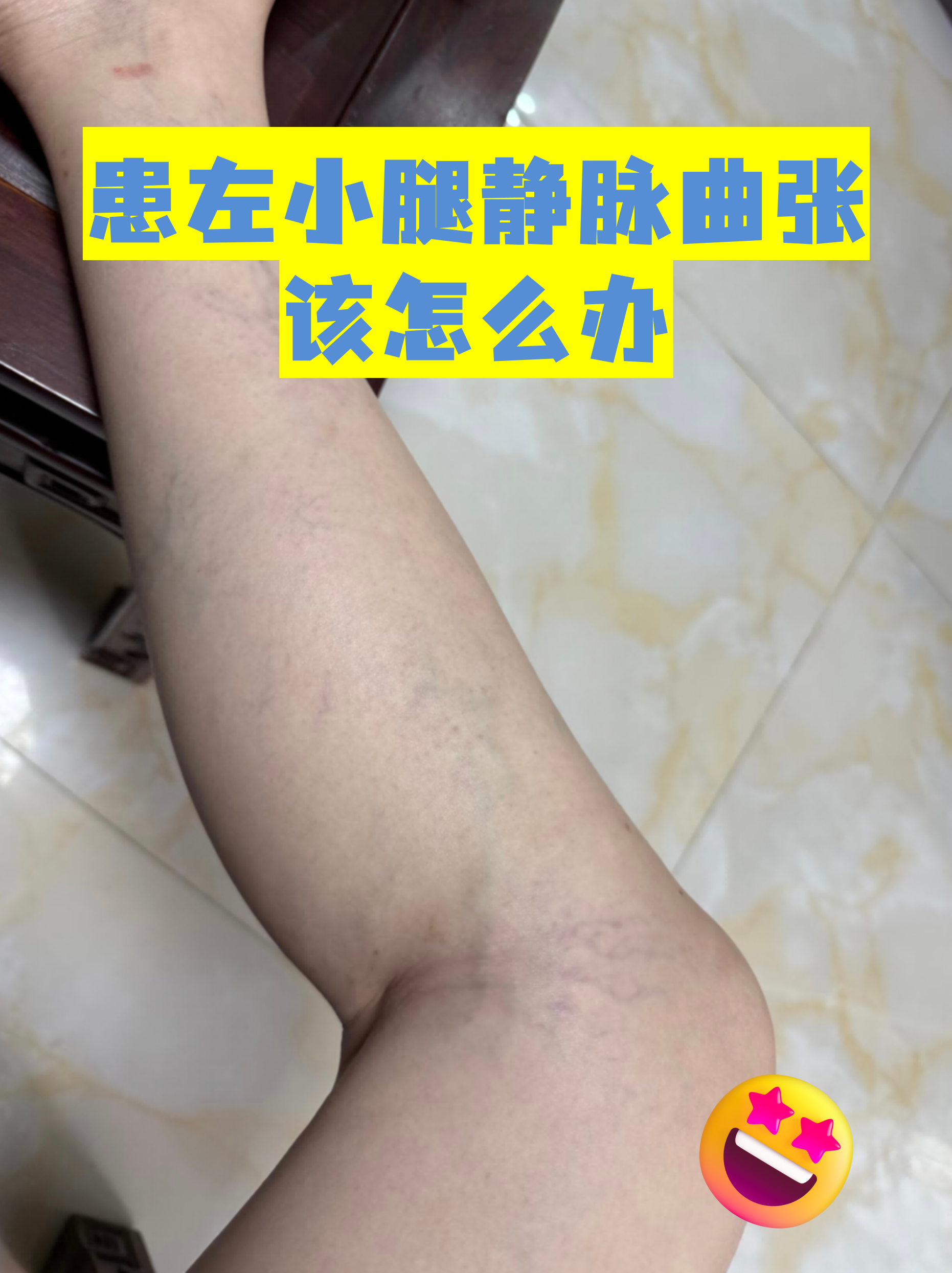 "患左小腿静脉曲张该怎么办