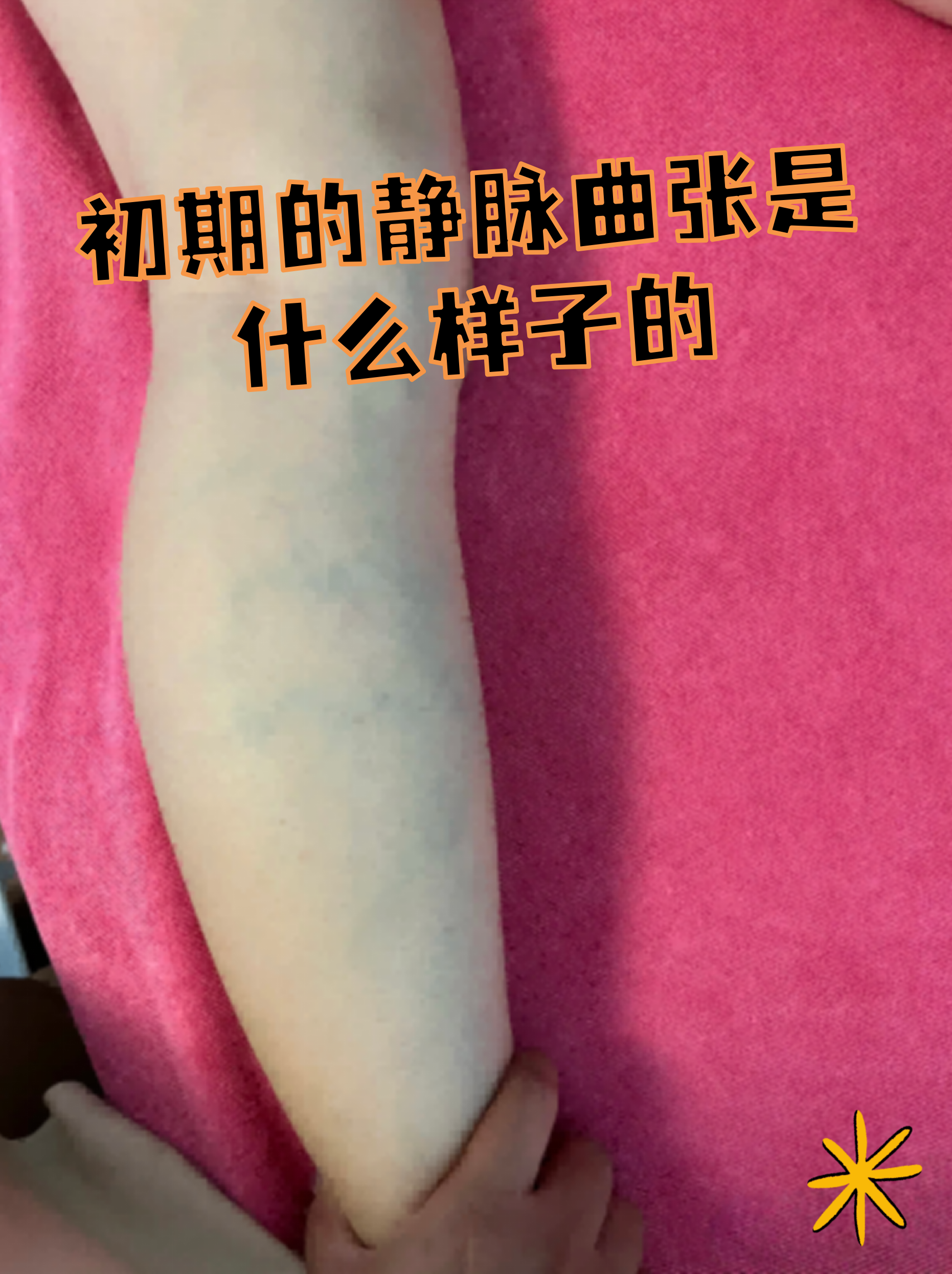 静脉曲张初期表现 轻微血管显露:站立时小腿或大腿内侧