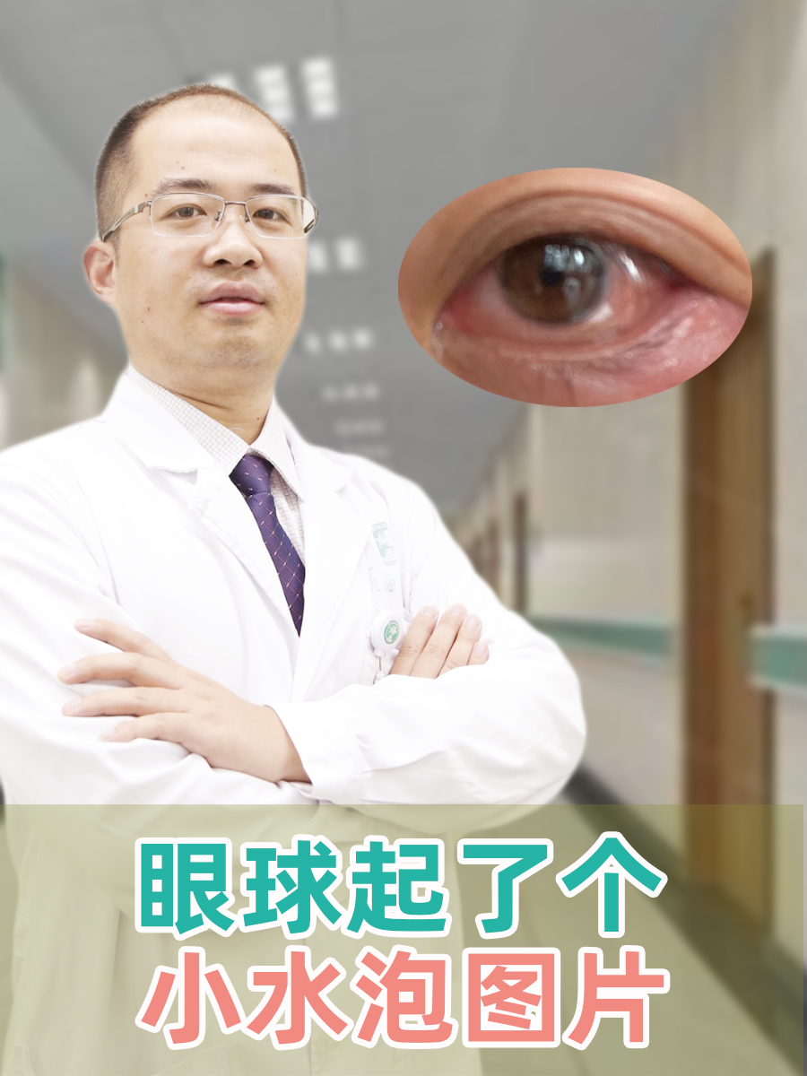这个小水泡可能出现在眼球的表面,如结膜处,也可能在其他位置.