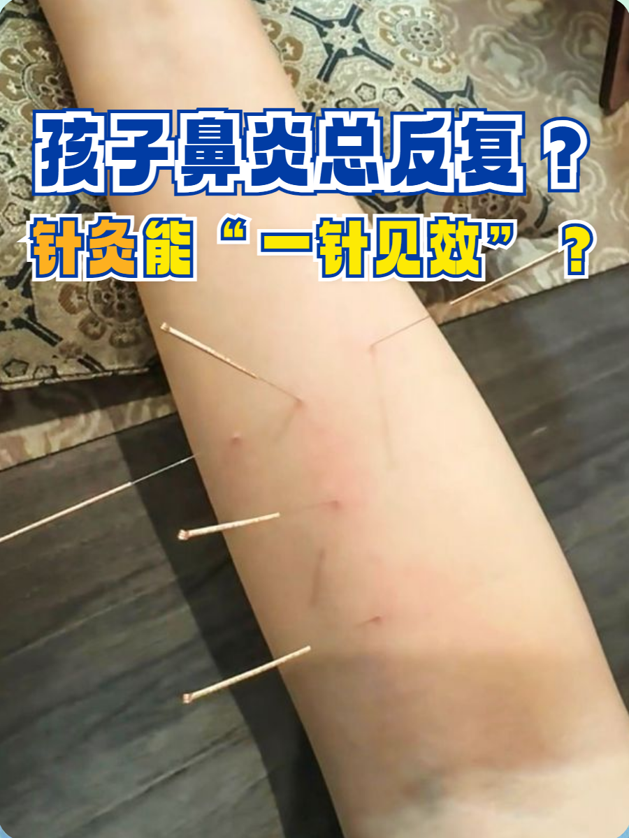 孩子鼻炎总反复?针灸能"一针见效"?