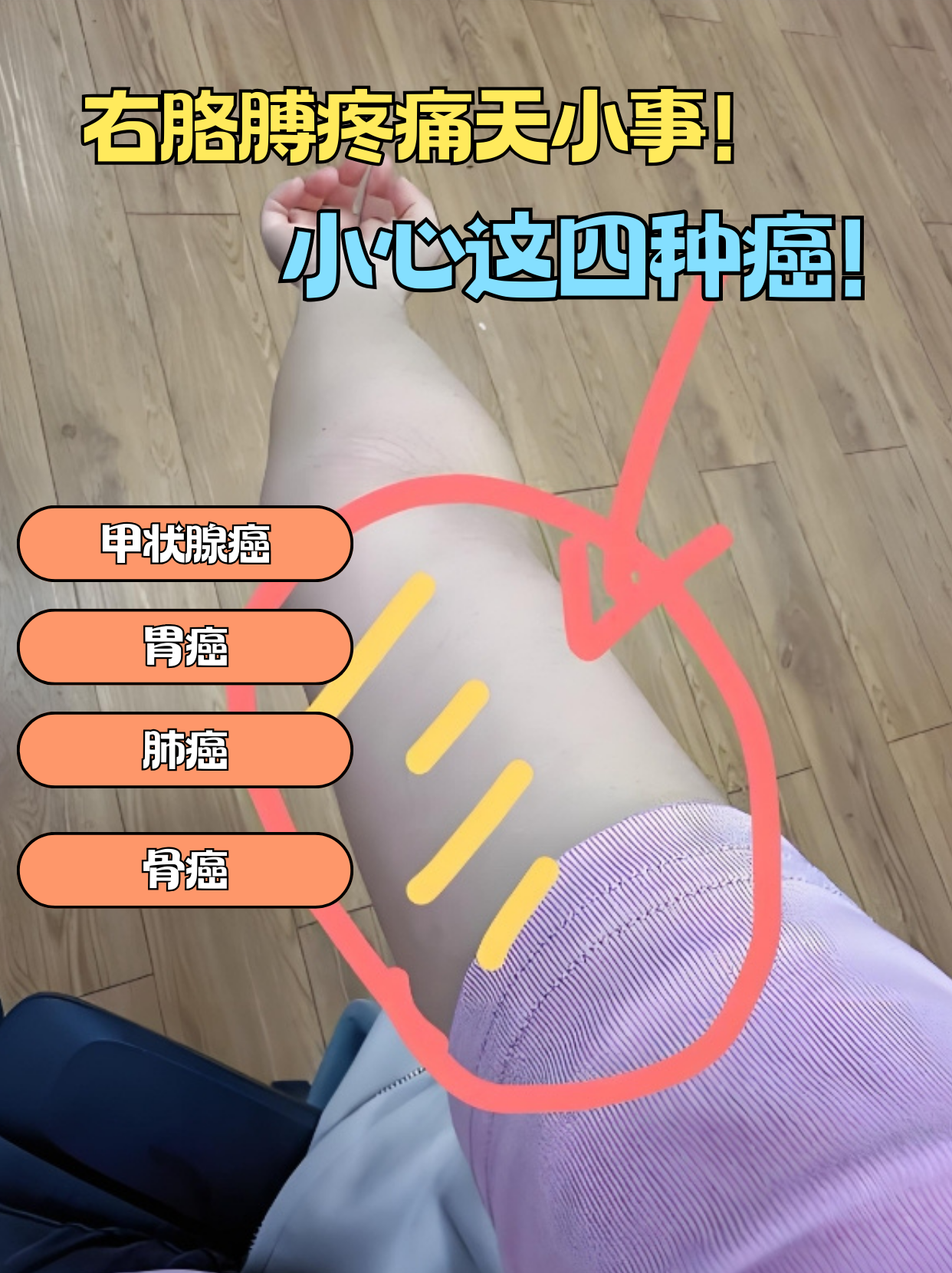 右胳膊疼痛可能与这四种癌症有关 肢体疼痛是常见不适,但若右胳膊出现