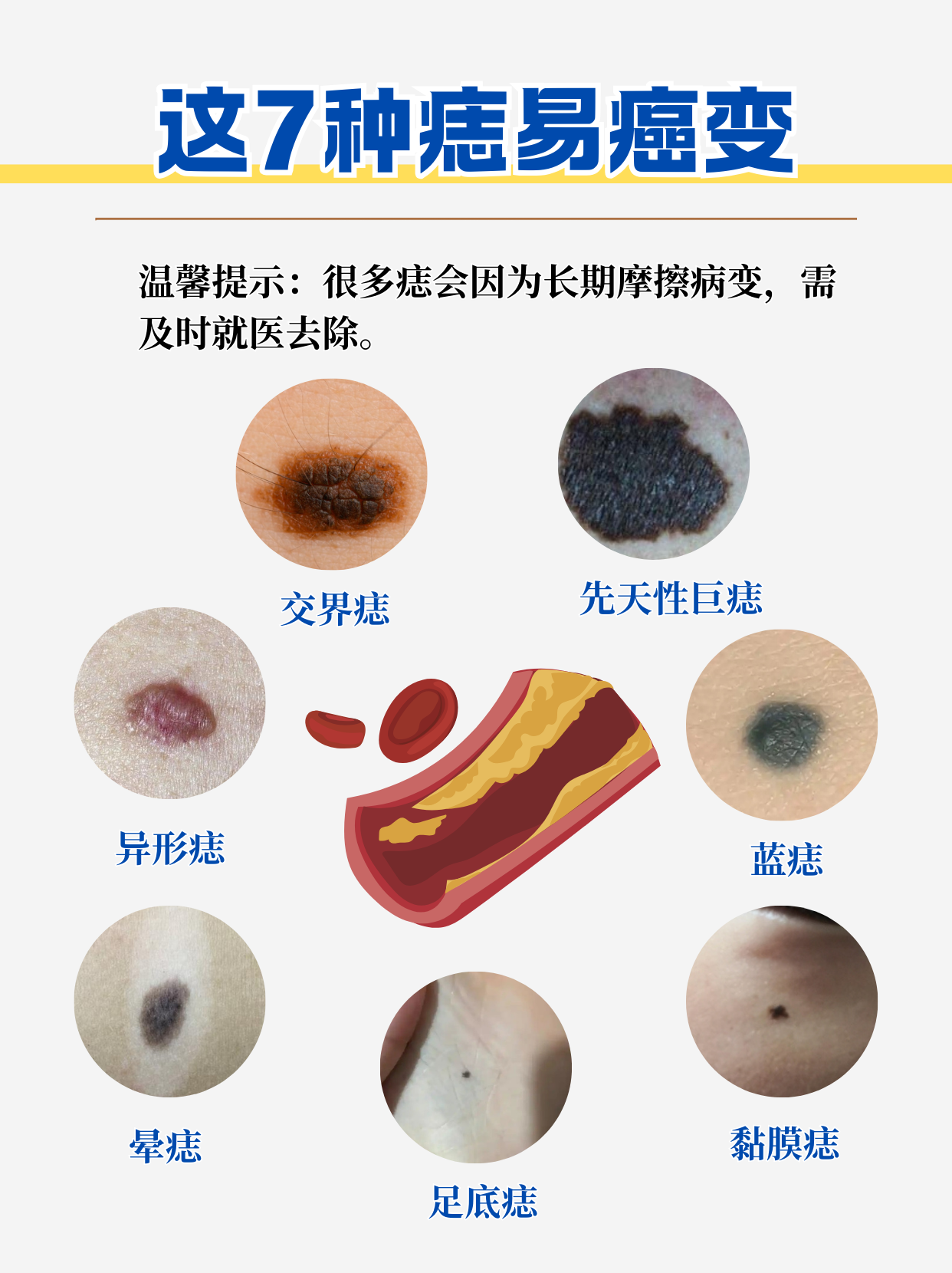 普通黑痣恶变会有征兆 在我们身上,痣是最常见的皮肤表现之一,多数