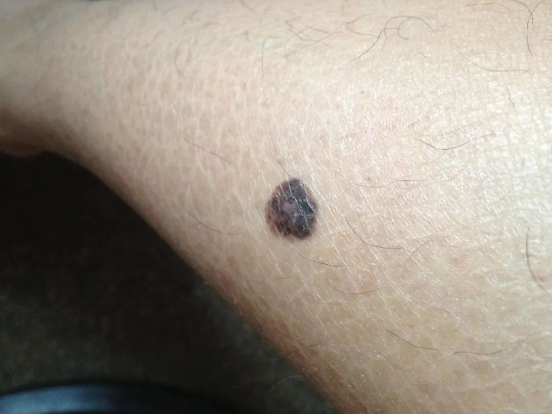 原位黑色素瘤解密:早期皮肤癌的含义与重要性 原位黑色素瘤是皮肤癌的