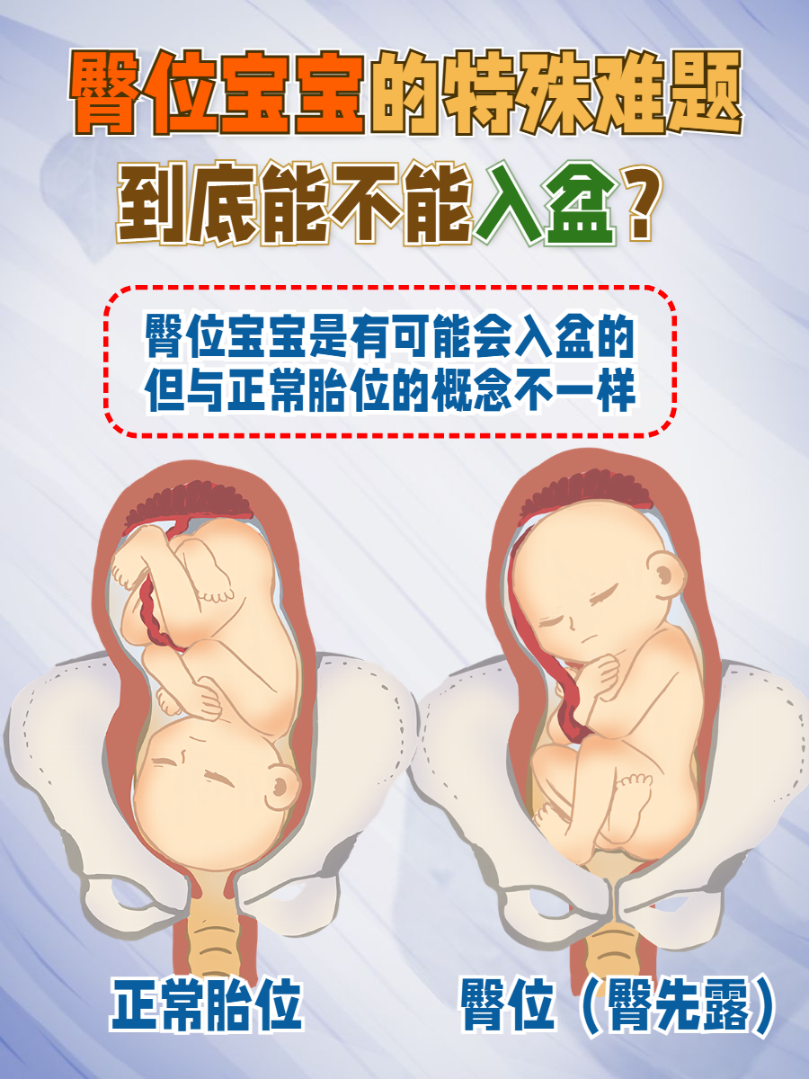 臀位宝宝的特殊难题:到底能不能入盆?