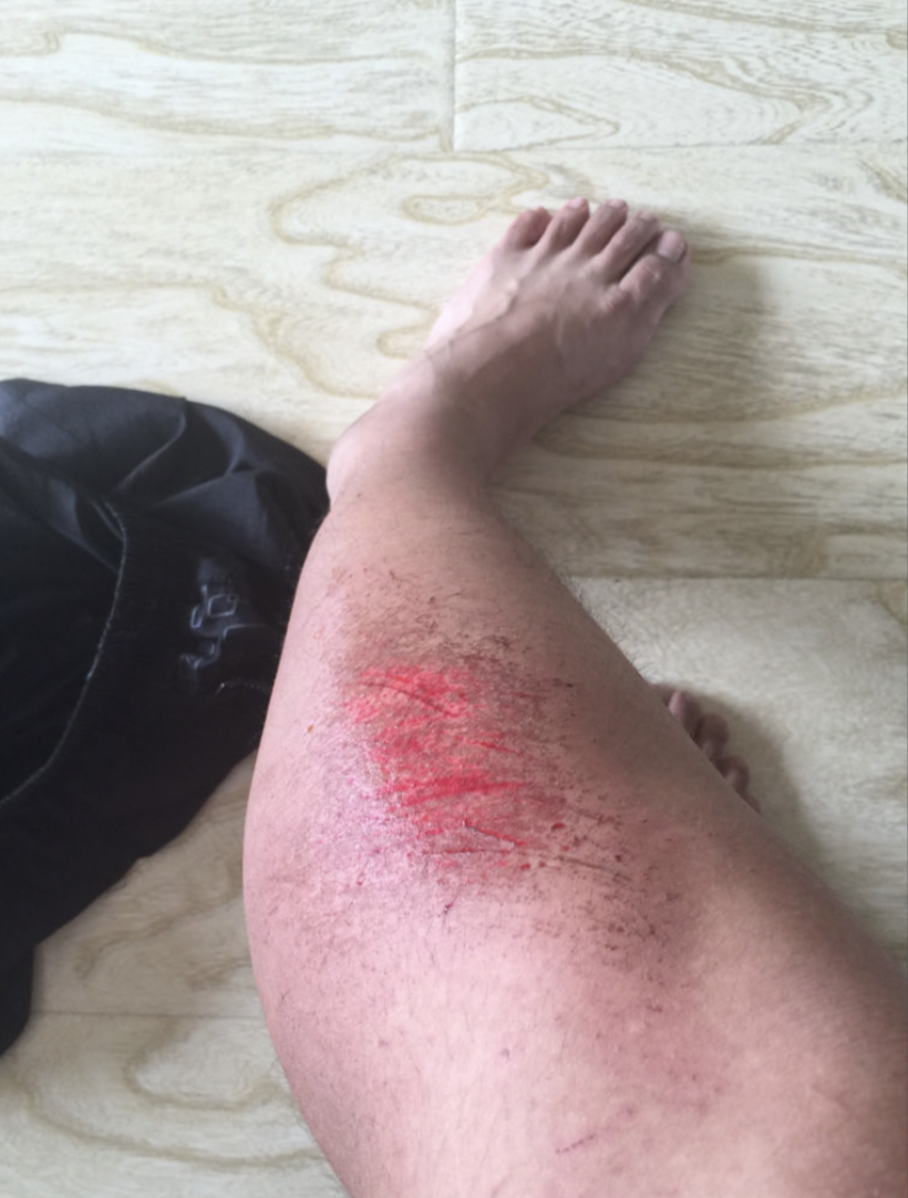 是一个重要信号,提示损伤可能不止于表面,或并发了感染等更深层的问题