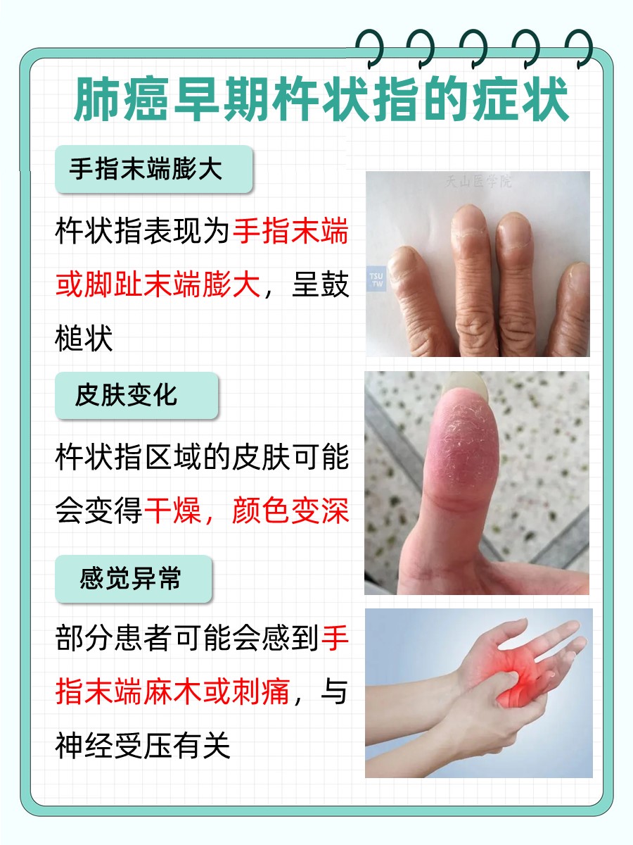 医生解答:肺癌早期杵状指的症状  肺癌,作为一种常见的恶性肿瘤,其