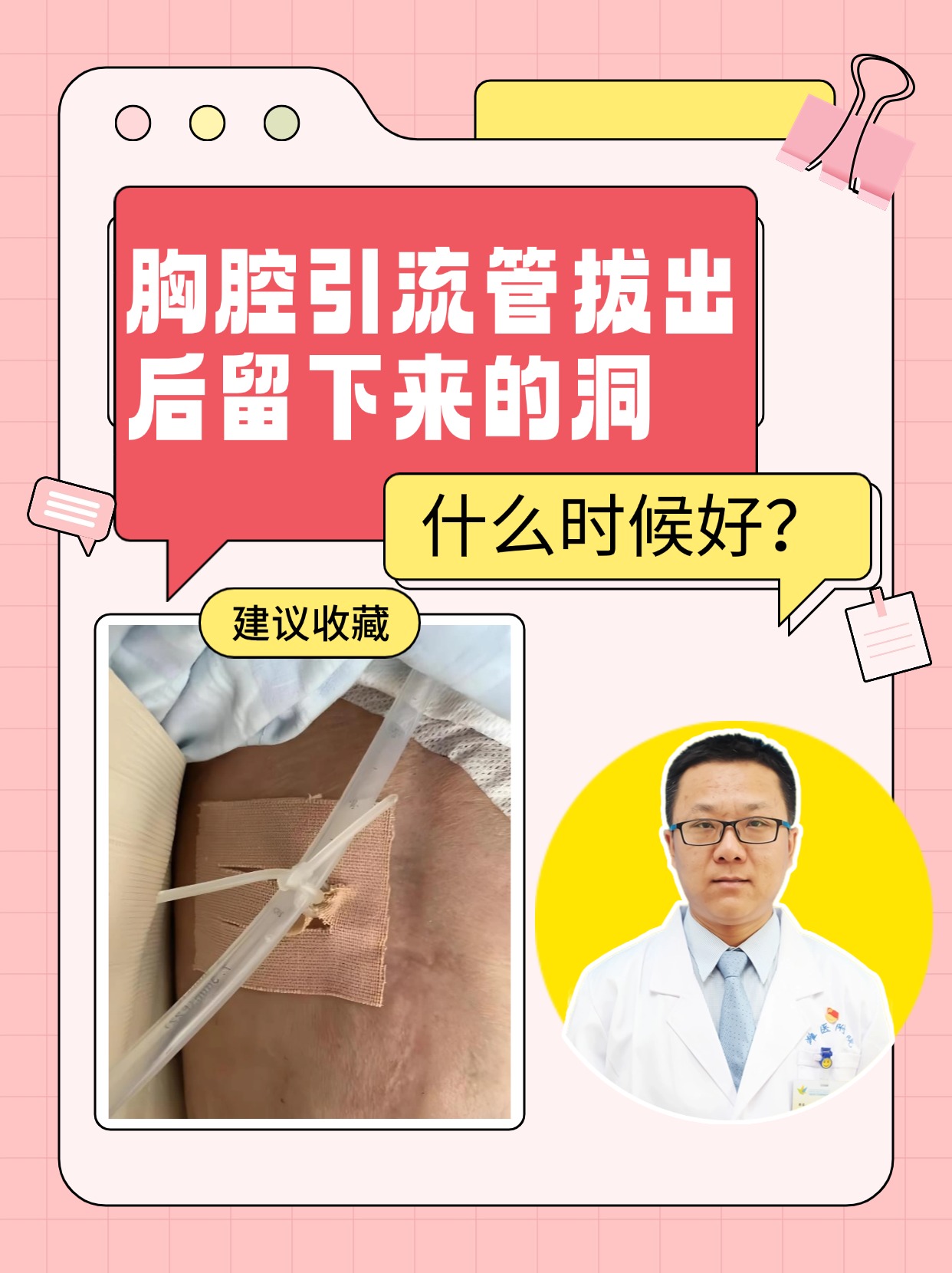胸腔引流管拔出后留下来的洞,什么时候好?