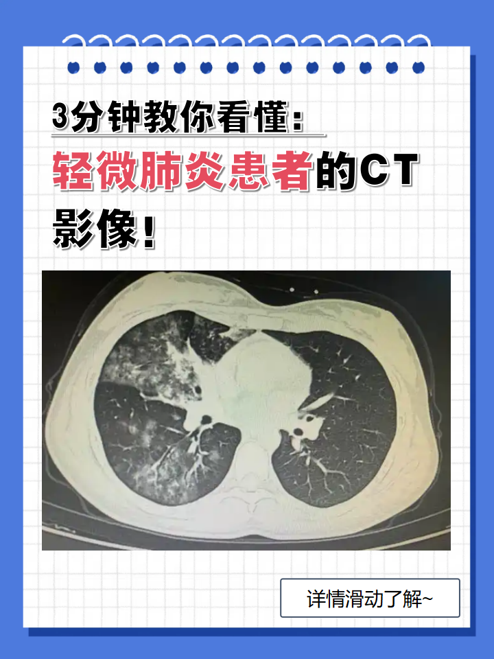 3分钟教你看懂:轻微肺炎患者的ct影像!