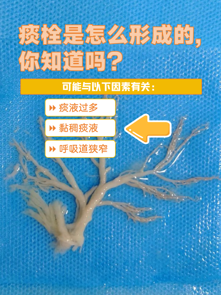 痰栓是怎么形成的,你知道吗?