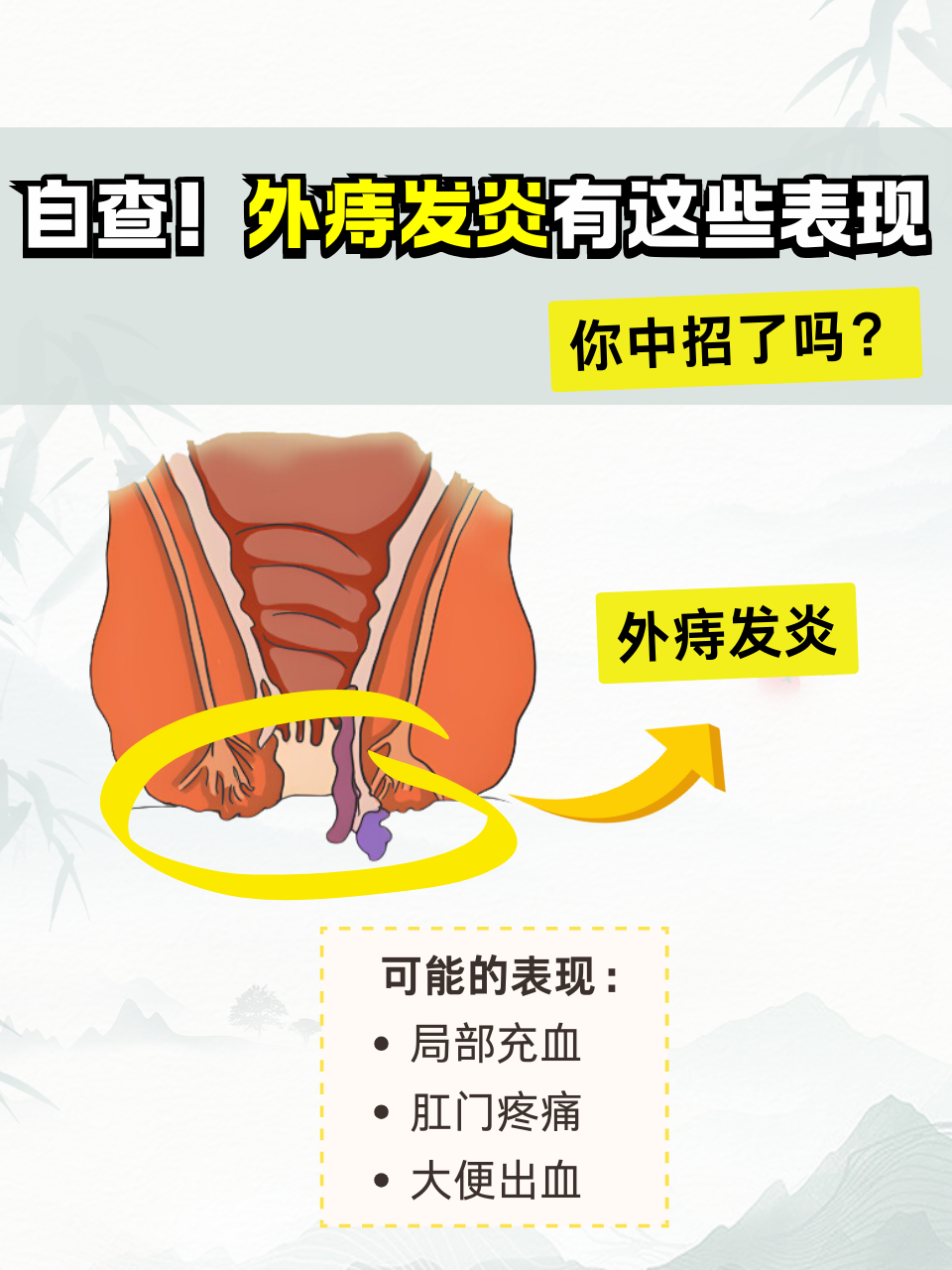 痔疮为什么疼