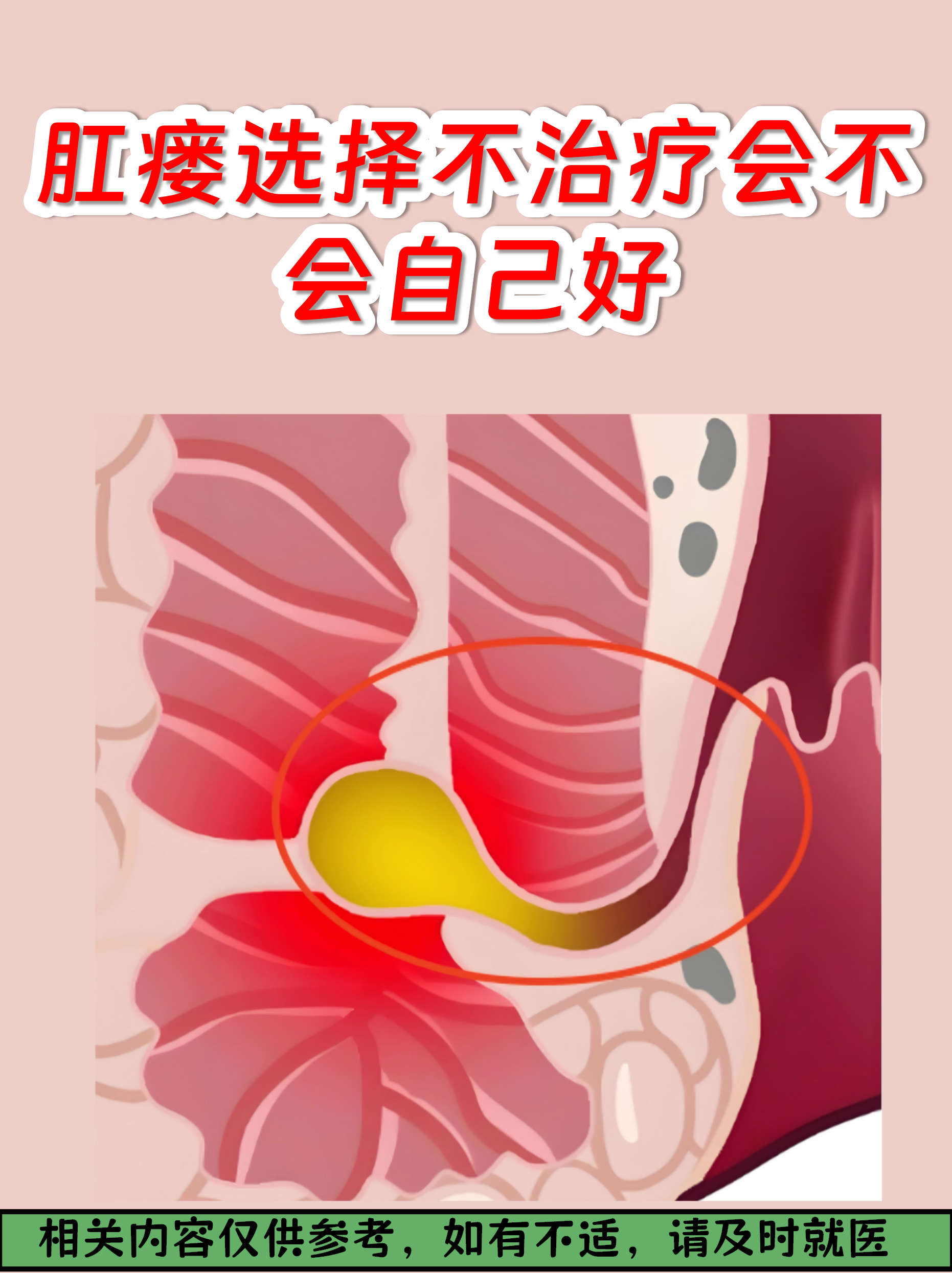 为什么会得肛瘘