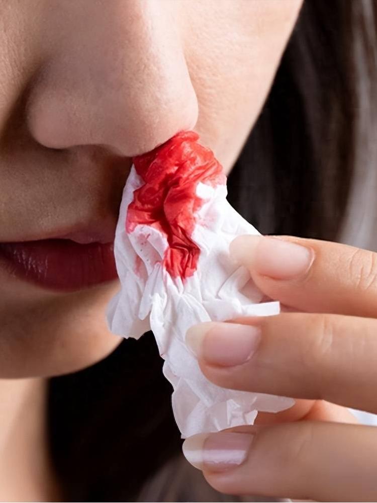 不断流鼻血是怎么引起的