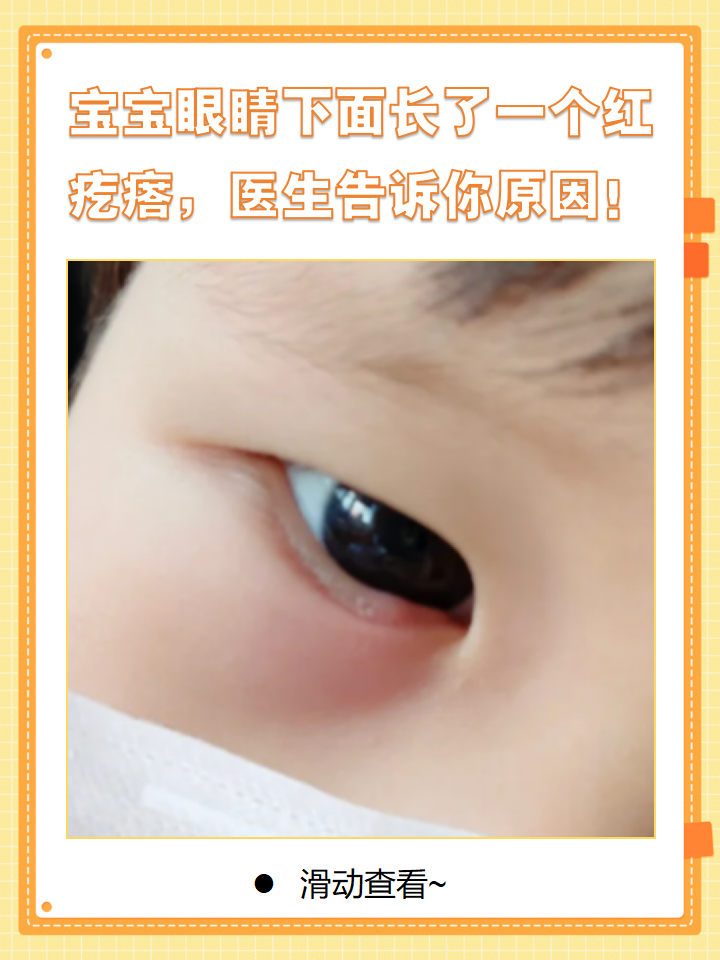 通常有以下几个原因: 蚊虫叮咬 湿疹 睑板腺囊肿 如何应对 保持眼部