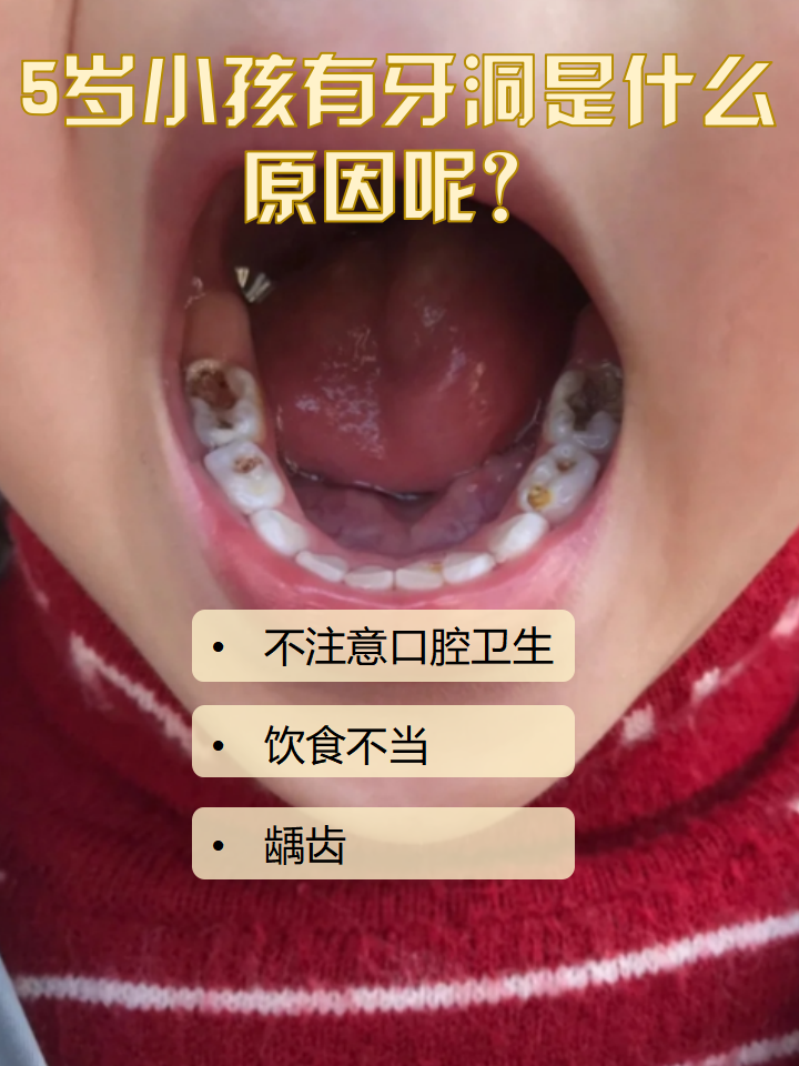 5岁小孩有牙洞,这种情况其实很常见,那么是什么原因引起的呢?