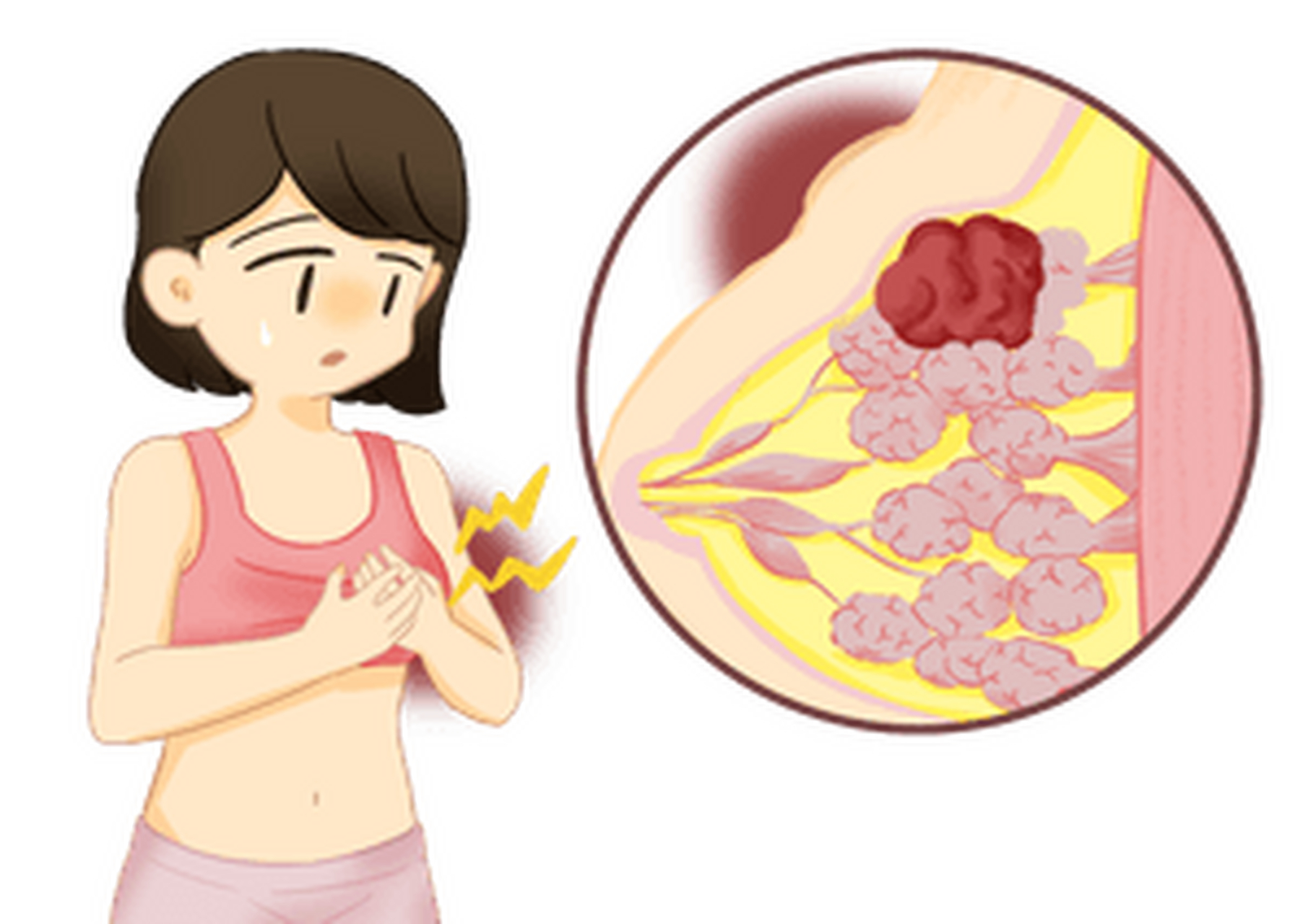 乳腺结节是女性乳腺疾病中常见的一种表现,其形成原因较为复杂,涉及