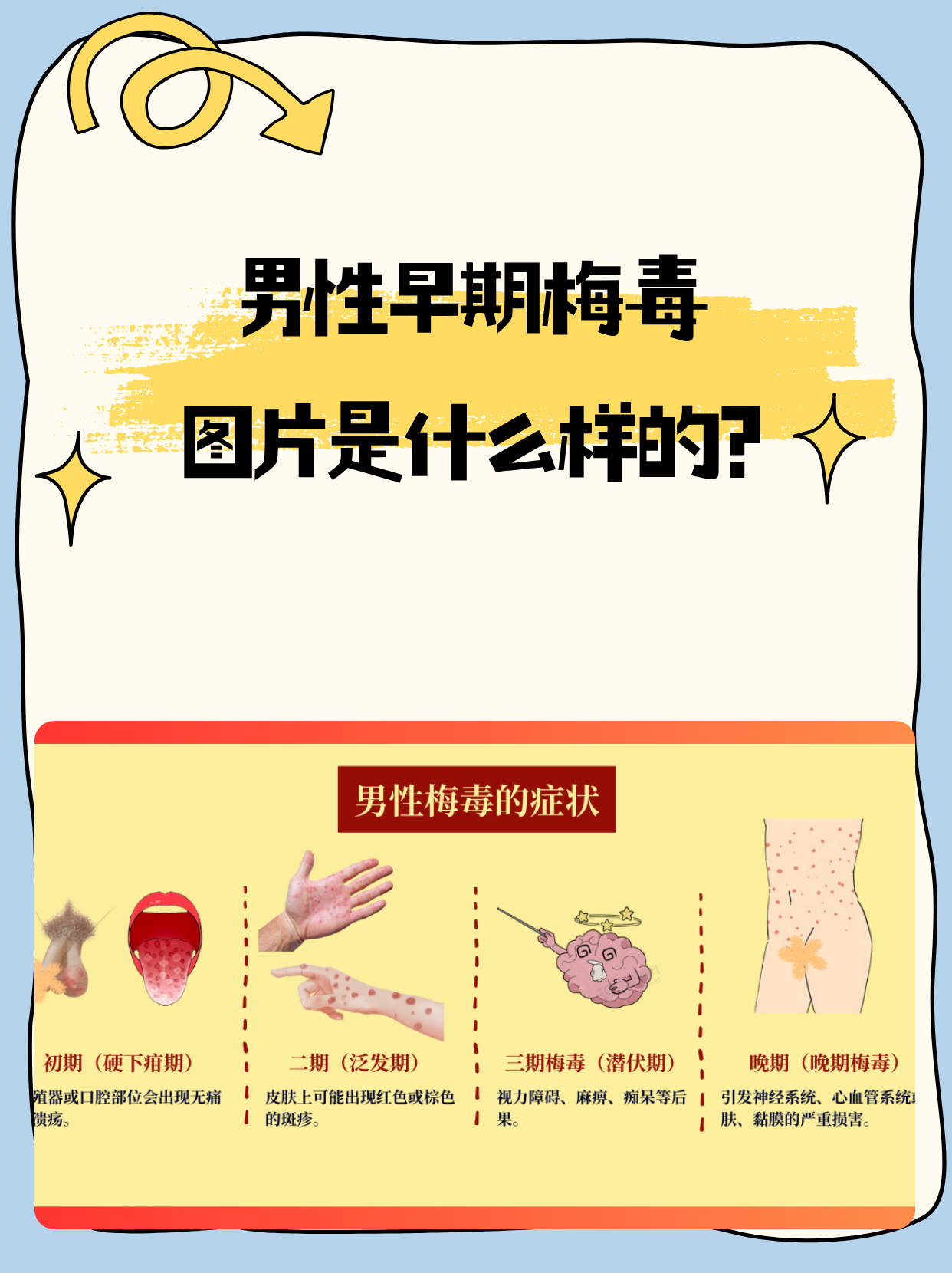 男性早期梅毒一般会在感染后2到4周出现症状,最常见的表现是生殖器