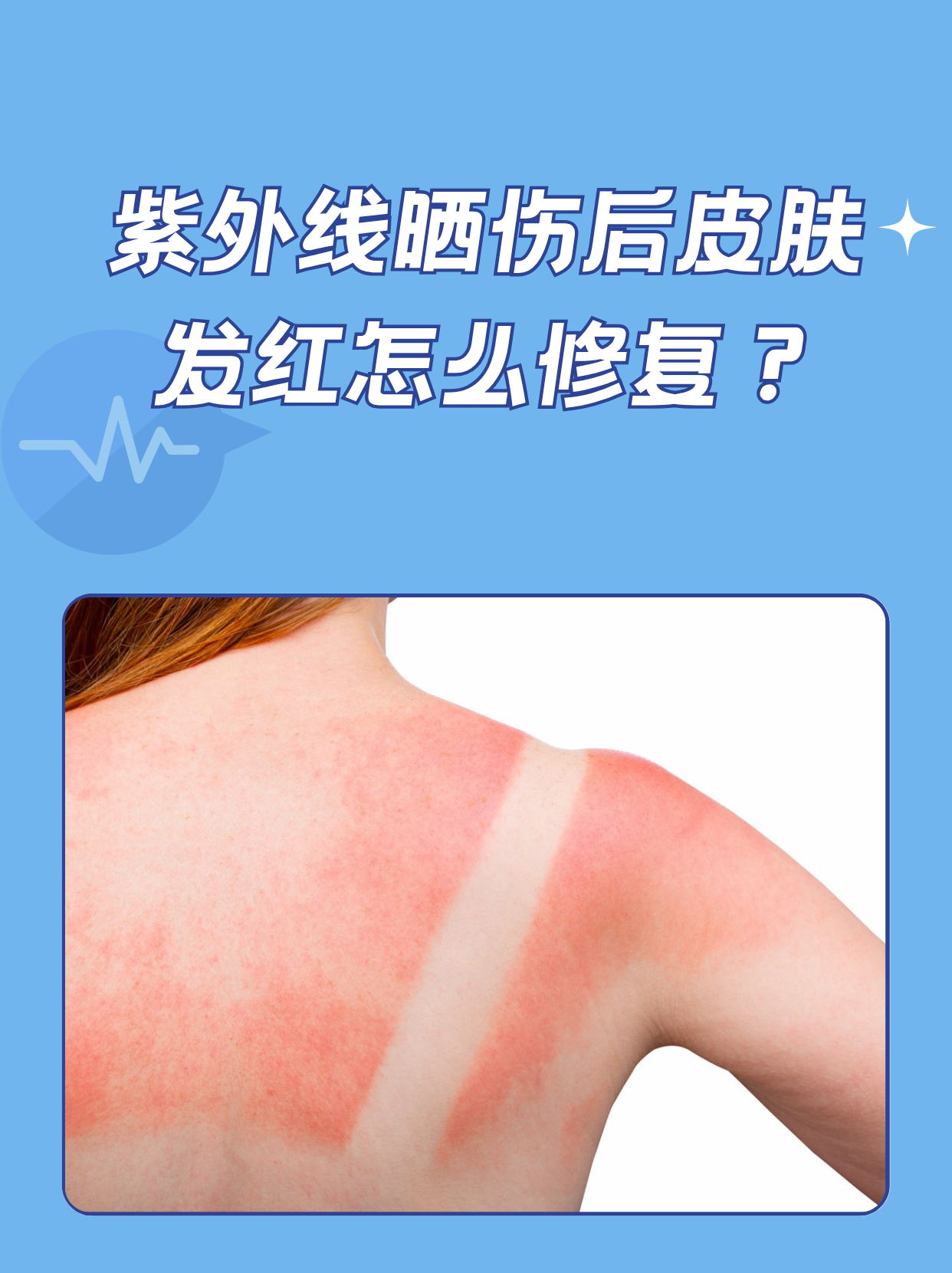 紫外线晒伤后皮肤发红怎么修复?