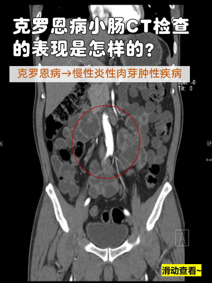 克罗恩病 是一种胃肠道慢性炎性肉芽肿性疾病,在胃肠道的任何
