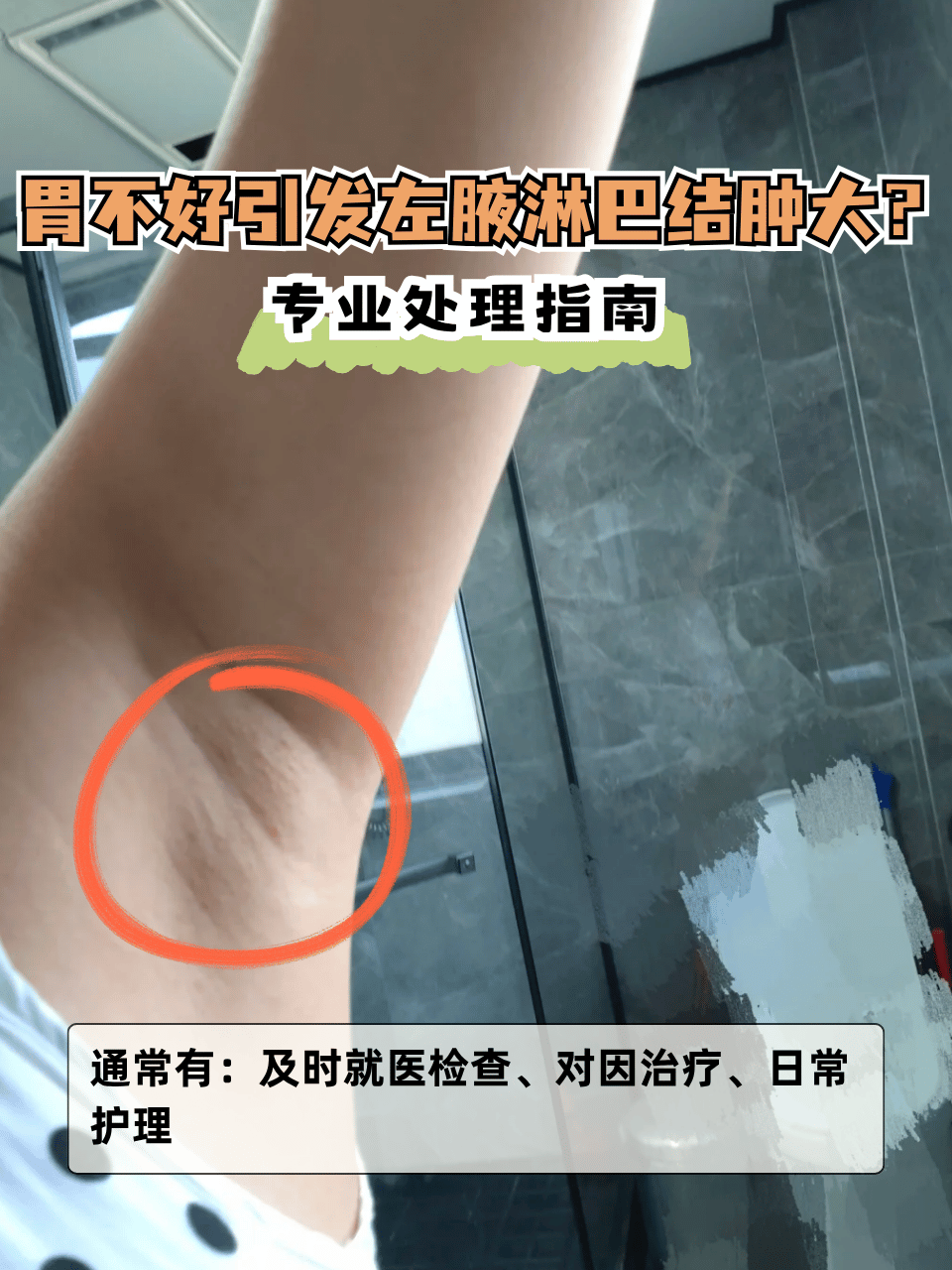 感染,炎症因子随淋巴循环波及腋窝淋巴结;也胳膊肘淋巴结肿大左乳切除