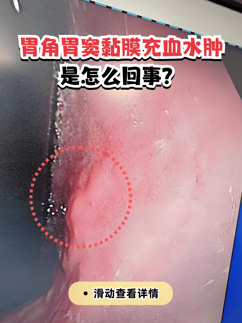 胃角胃窦黏膜充血水肿多由胃炎,胃溃疡等胃部疾病引起,也可能与布良
