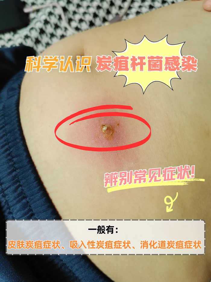 炭疽杆菌是炭疽的病原体,如果感染炭疽杆菌,可能会引起人体不同器官