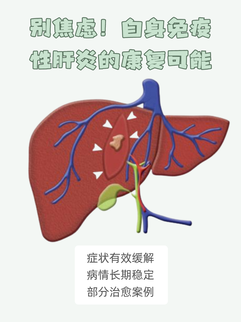 自身免疫性肝炎的康复可能