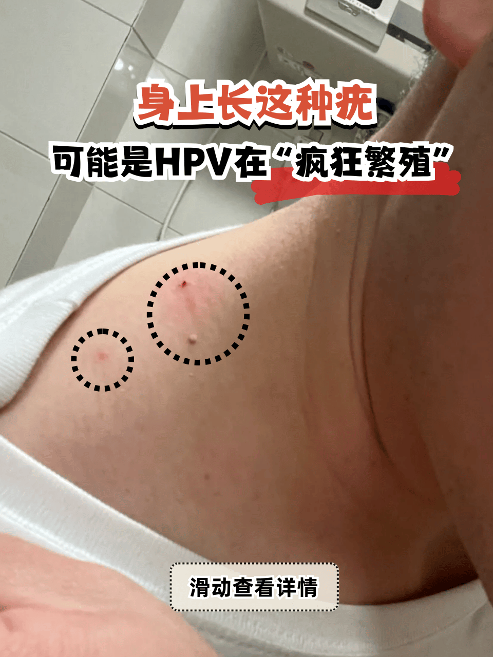 hpv疣体特征识别 菜花状赘生物 丝状凸起形态 扁平丘疹表现