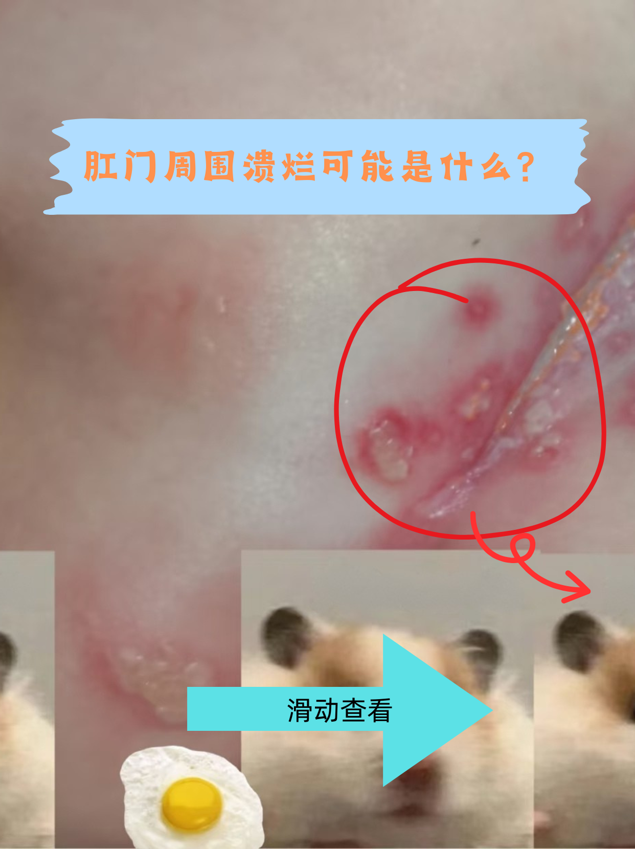肛门周围皮肤出现溃烂时,可能是多种因素导致的局部炎症反应