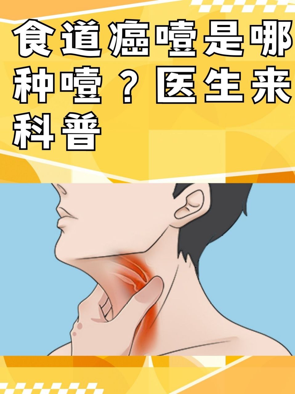 医生来科普   97食道癌,也被称为食管癌,是发生在食道(也就是连接