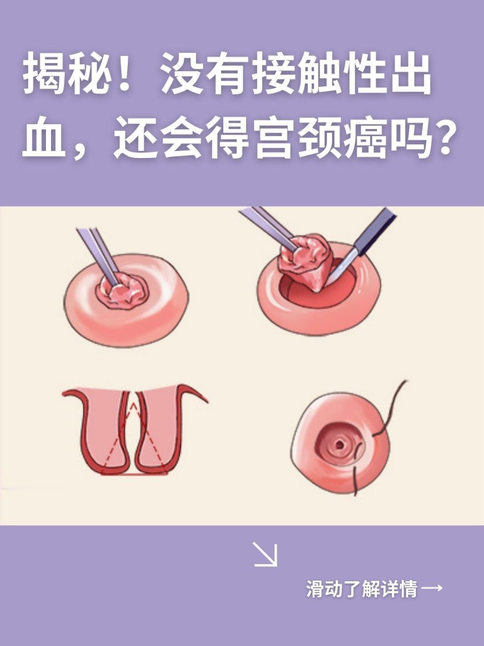 因为早期宫颈癌患者可能没有明显症状,尤其是宫颈原位癌和早期宫颈